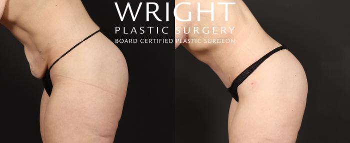Before & After Tummy Tuck Case 429 Left Side View in Little Rock, Arkansas