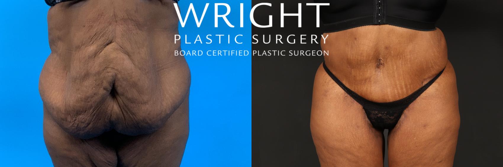 Before & After Tummy Tuck Case 431 Front View in Little Rock, Arkansas