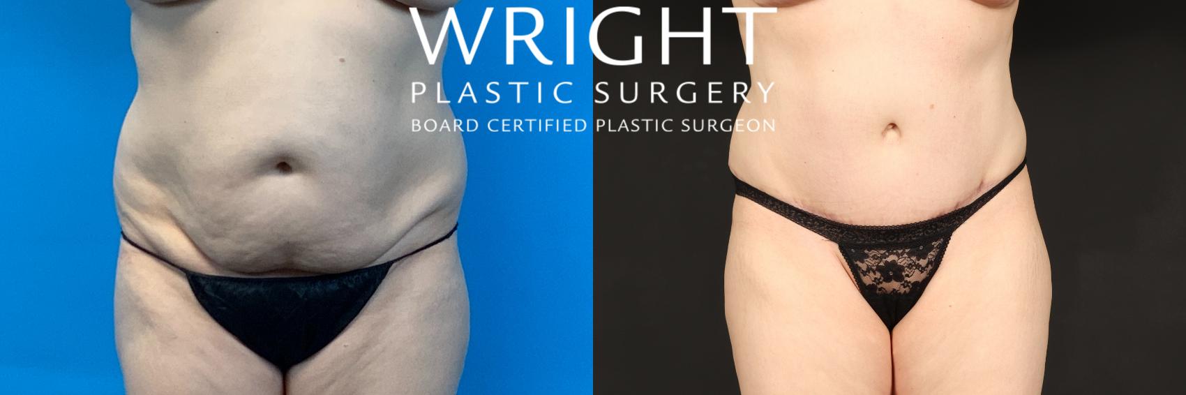 Before & After Tummy Tuck Case 436 Front View in Little Rock, Arkansas