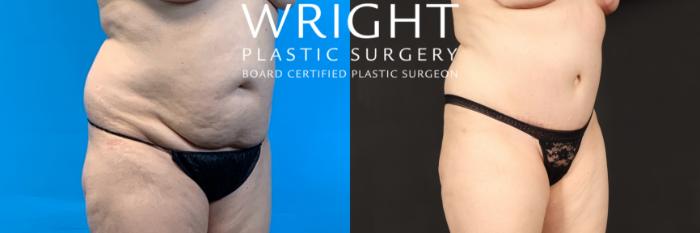 Before & After Liposuction Case 436 Right Oblique View in Little Rock, Arkansas