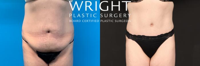 Before & After Tummy Tuck Case 440 Front View in Little Rock, Arkansas