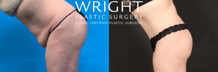 Before & After Tummy Tuck Case 440 Left Side View in Little Rock, Arkansas