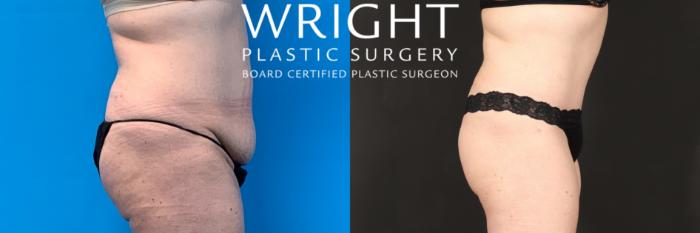Before & After Tummy Tuck Case 440 Right Side View in Little Rock, Arkansas
