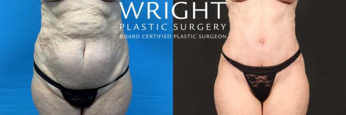Before & After Tummy Tuck Case 443 Front View in Little Rock, Arkansas