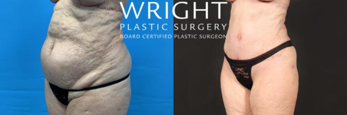 Before & After Tummy Tuck Case 443 Left Oblique View in Little Rock, Arkansas