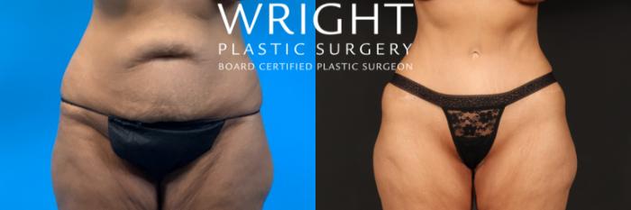 Before & After Tummy Tuck Case 450 Front View in Little Rock, Arkansas