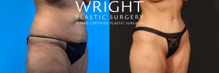 Before & After Liposuction Case 450 Right Oblique View in Little Rock, Arkansas