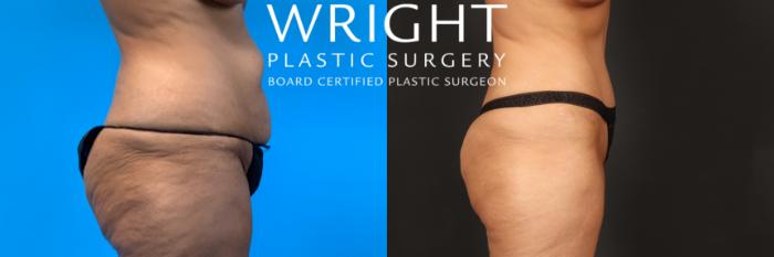 Before & After Tummy Tuck Case 450 Right Side View in Little Rock, Arkansas