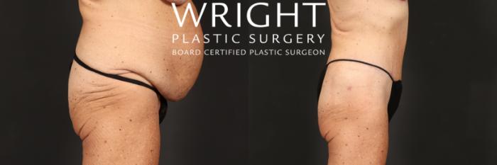 Before & After Tummy Tuck Case 456 Right Side View in Little Rock, Arkansas