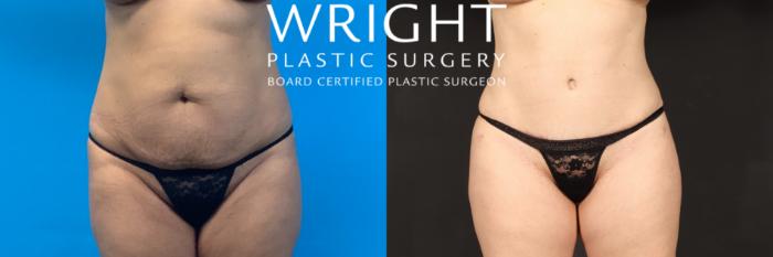 Before & After Tummy Tuck Case 459 Front View in Little Rock, Arkansas
