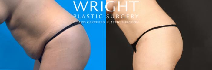 Before & After Tummy Tuck Case 459 Left Side View in Little Rock, Arkansas