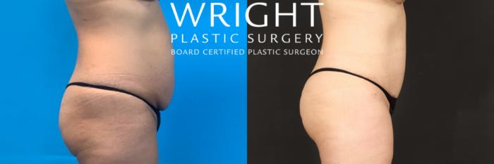 Before & After Tummy Tuck Case 459 Right Side View in Little Rock, Arkansas