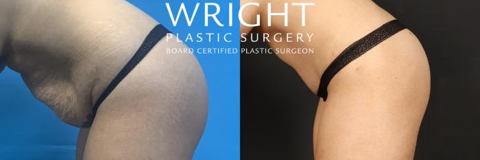 Before & After Tummy Tuck Case 464 Left side bending over View in Little Rock, Arkansas
