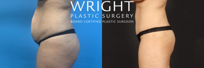 Before & After Tummy Tuck Case 464 Left Side View in Little Rock, Arkansas