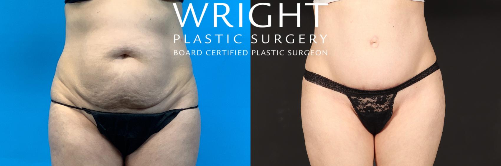 Before & After Tummy Tuck Case 472 Front View in Little Rock, Arkansas