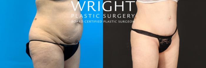 Before & After Tummy Tuck Case 472 Right Oblique View in Little Rock, Arkansas