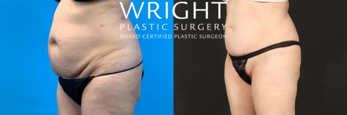 Before & After Tummy Tuck Case 472 Right Side View in Little Rock, Arkansas