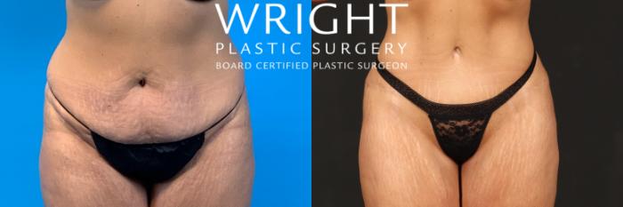 Before & After Tummy Tuck Case 477 Front View in Little Rock, Arkansas