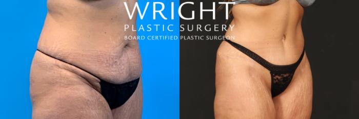 Before & After Tummy Tuck Case 477 Right Oblique View in Little Rock, Arkansas