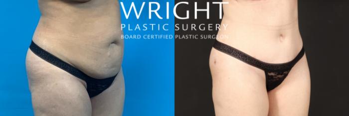Before & After Tummy Tuck Case 478 Right Oblique View in Little Rock, Arkansas