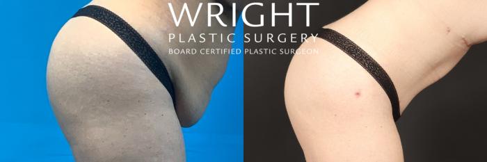 Before & After Tummy Tuck Case 478 Right Side View in Little Rock, Arkansas