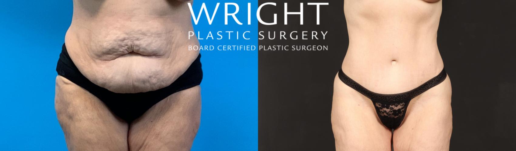 Before & After Tummy Tuck Case 487 Front View in Little Rock, Arkansas