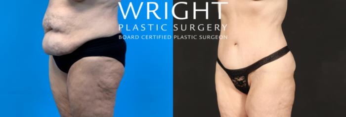 Before & After Tummy Tuck Case 487 Left Oblique View in Little Rock, Arkansas