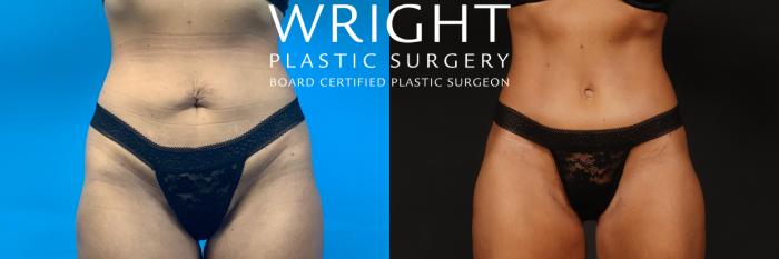 Before & After Tummy Tuck Case 494 Front View in Little Rock, Arkansas