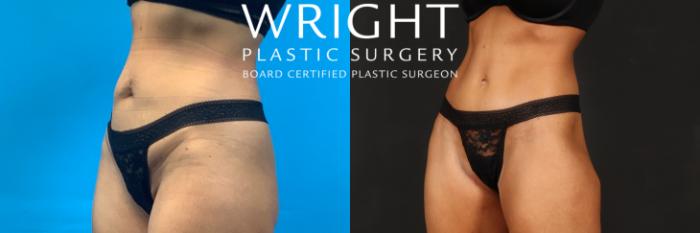 Before & After Liposuction Case 494 Left Oblique View in Little Rock, Arkansas