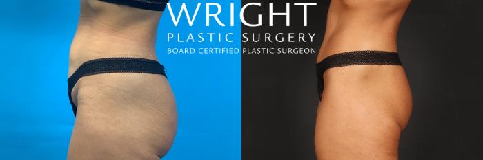 Before & After Liposuction Case 494 Left Side View in Little Rock, Arkansas