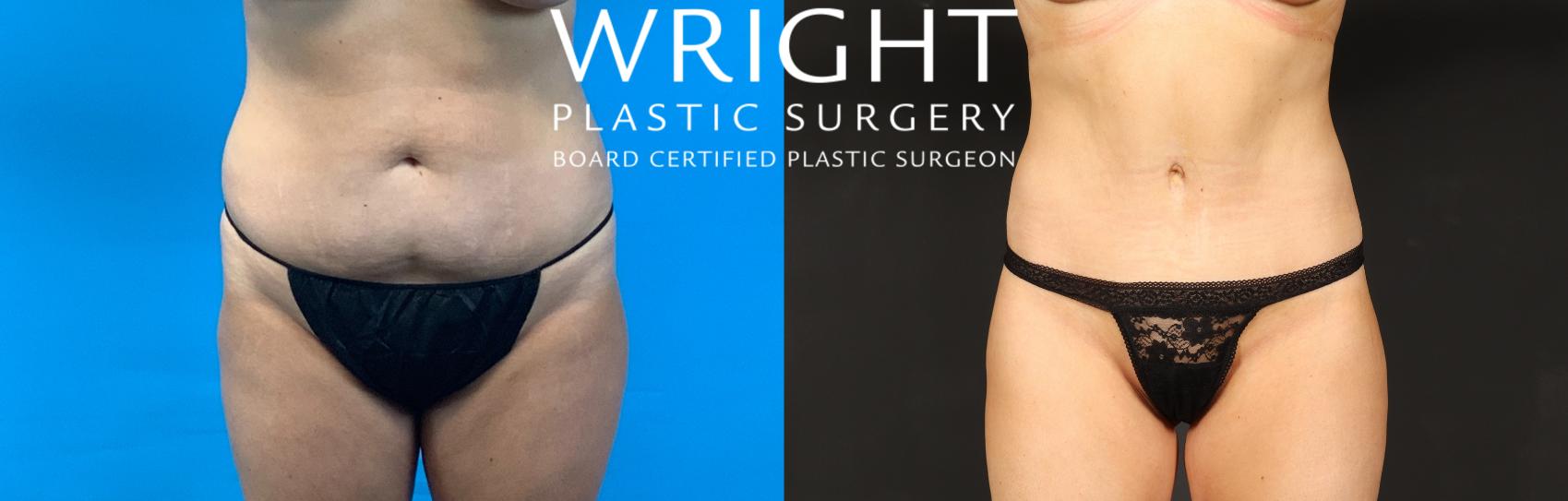 Before & After Tummy Tuck Case 496 Front View in Little Rock, Arkansas