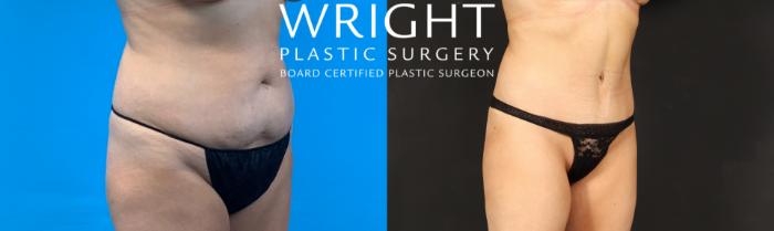 Before & After Tummy Tuck Case 496 Right Oblique View in Little Rock, Arkansas