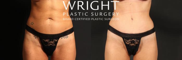 Before & After Tummy Tuck Case 500 Front View in Little Rock, Arkansas