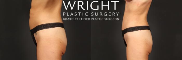 Before & After Tummy Tuck Case 500 Left Side View in Little Rock, Arkansas