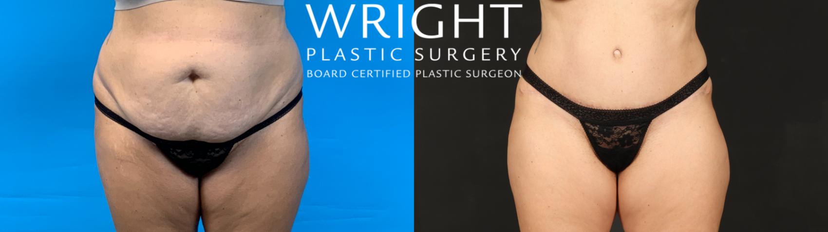 Before & After Tummy Tuck Case 507 Front View in Little Rock, Arkansas