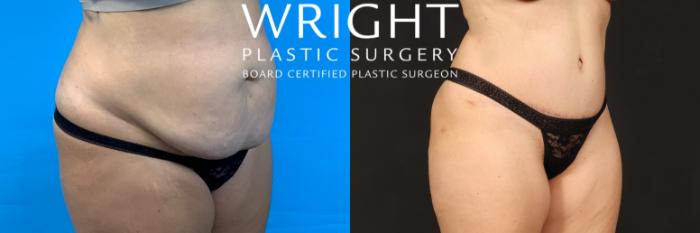 Before & After Liposuction Case 507 Right Oblique View in Little Rock, Arkansas