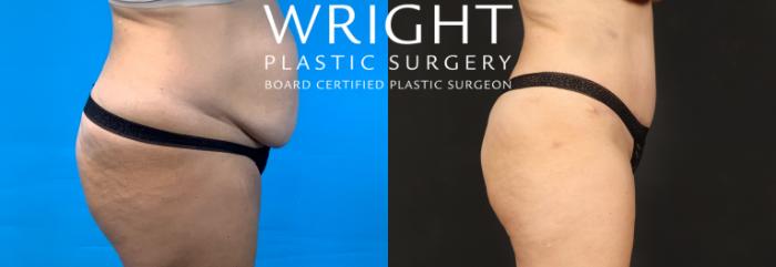 Before & After Tummy Tuck Case 507 Right Side View in Little Rock, Arkansas