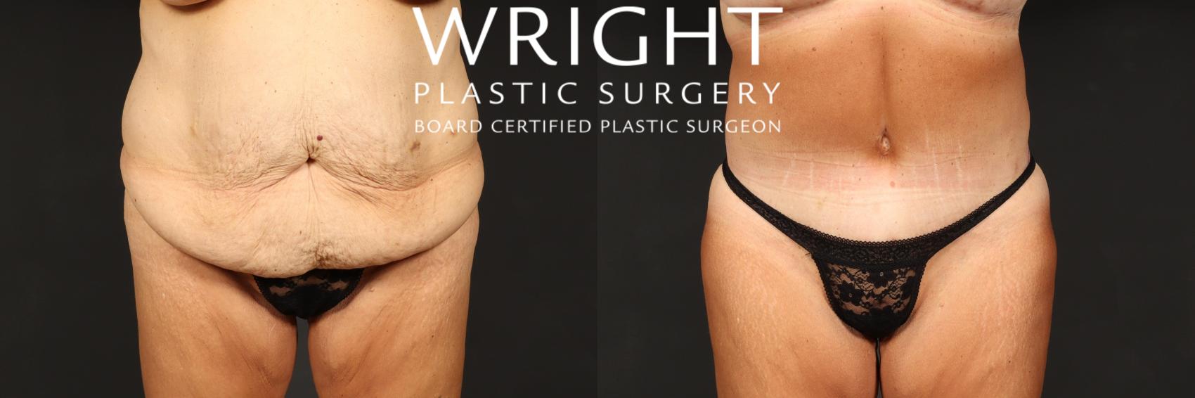 Before & After Tummy Tuck Case 513 Front View in Little Rock, Arkansas