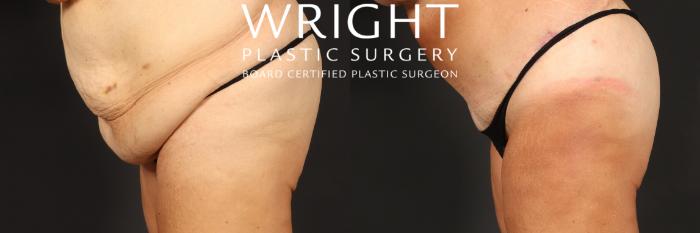 Before & After Tummy Tuck Case 513 Left side bending over View in Little Rock, Arkansas