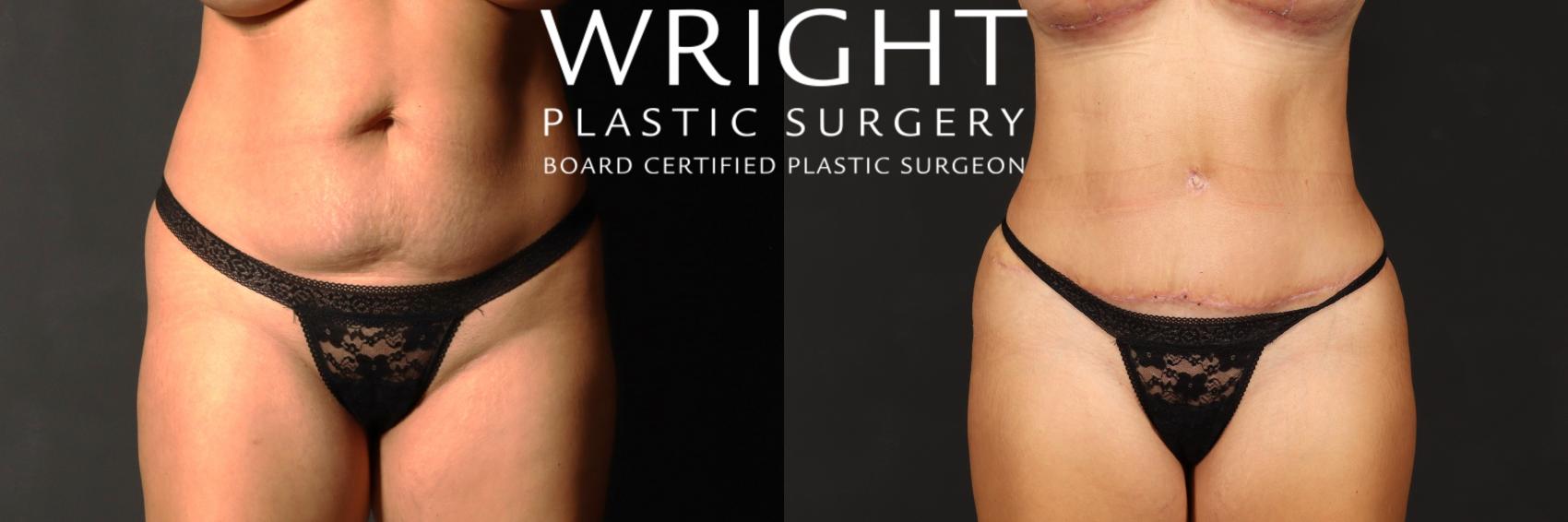 Before & After Liposuction Case 515 Front View in Little Rock, Arkansas