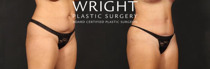 Before & After Tummy Tuck Case 515 Right Oblique View in Little Rock, Arkansas