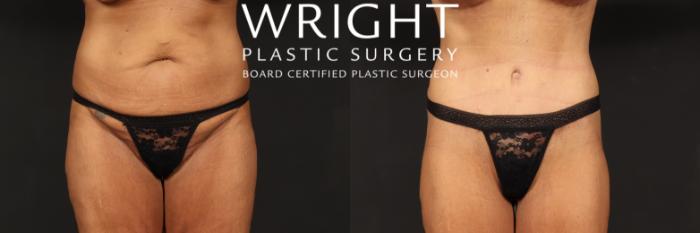 Before & After Tummy Tuck Case 518 Front View in Little Rock, Arkansas