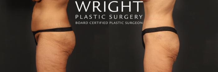 Before & After Tummy Tuck Case 518 Left Side View in Little Rock, Arkansas