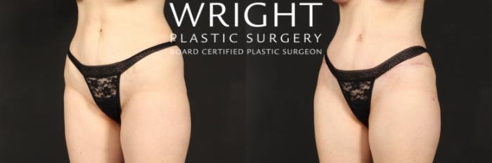 Before & After Tummy Tuck Case 519 Left Oblique View in Little Rock, Arkansas