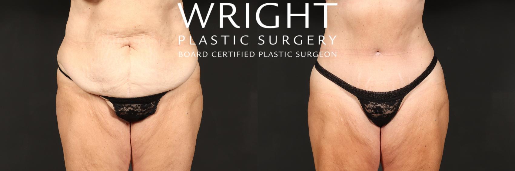 Before & After Tummy Tuck Case 537 Front View in Little Rock, Arkansas