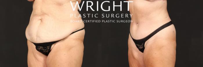 Before & After Tummy Tuck Case 537 Left Oblique View in Little Rock, Arkansas