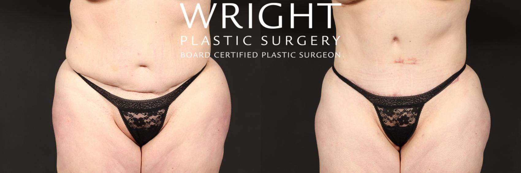 Before & After Tummy Tuck Case 544 Front View in Little Rock, Arkansas