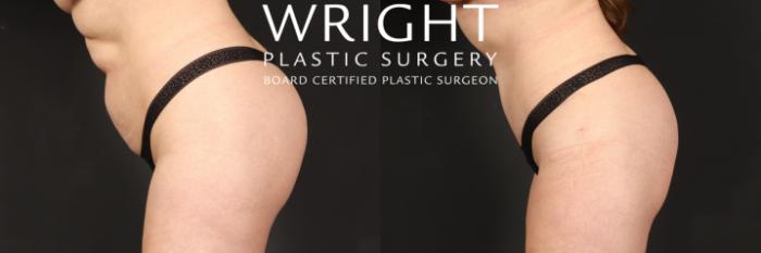 Before & After Tummy Tuck Case 549 Left side bending over View in Little Rock, Arkansas