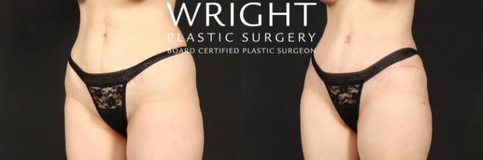 Before & After Tummy Tuck Case 551 Left Oblique View in Little Rock, Arkansas