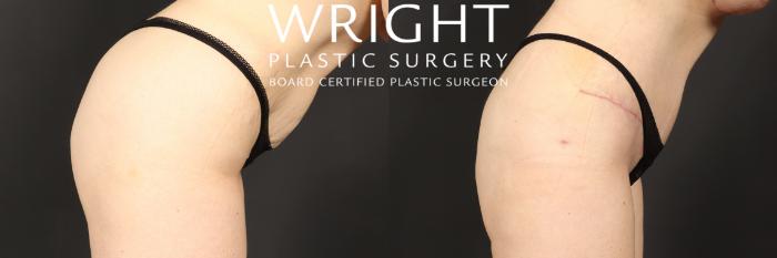 Before & After Tummy Tuck Case 551 Right Side View in Little Rock, Arkansas